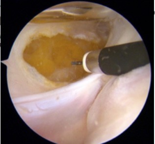 traumatologiapediatrica-inestabilidad-rotula-tecnicas-quirurgicas-Knorr.jpg