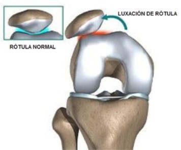 traumatologiapediatrica-inestabilidad-rotula-luxacion-rotula.jpg