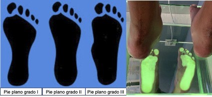 traumatologiapediatrica-pie-plano-infantil-grado-final