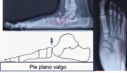 traumatologiapediatrica-pie-plano-infantil.podoscopio