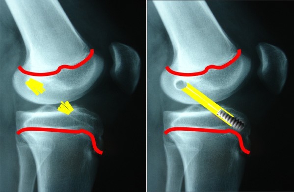 rotura ligamento cruzado anterior posterior