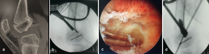 traumatologiapediatrica-epifisiodesis-fig1