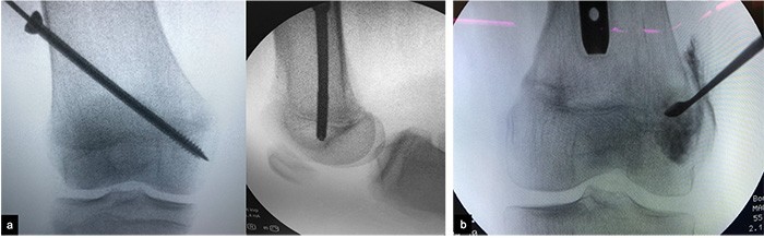 traumatologiapediatrica-epifisiodesis-fig4