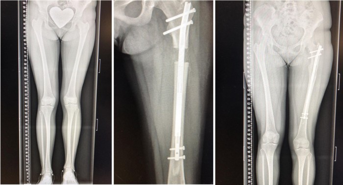 traumatologiapediatrica-epifisiodesis-fig3.j